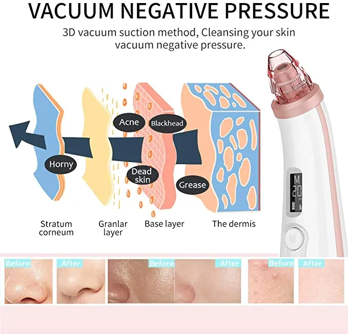 New ANLAN Swan Blackhead Vacuum Facial Pore Cleanser With Timing Function 3 Suction Levels 3 Replaceable Heads Rechargeable